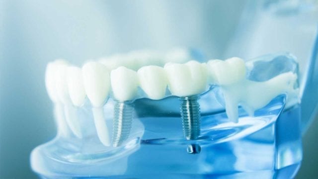 All You Need to Know about Dental Implants - WhiteOut Press